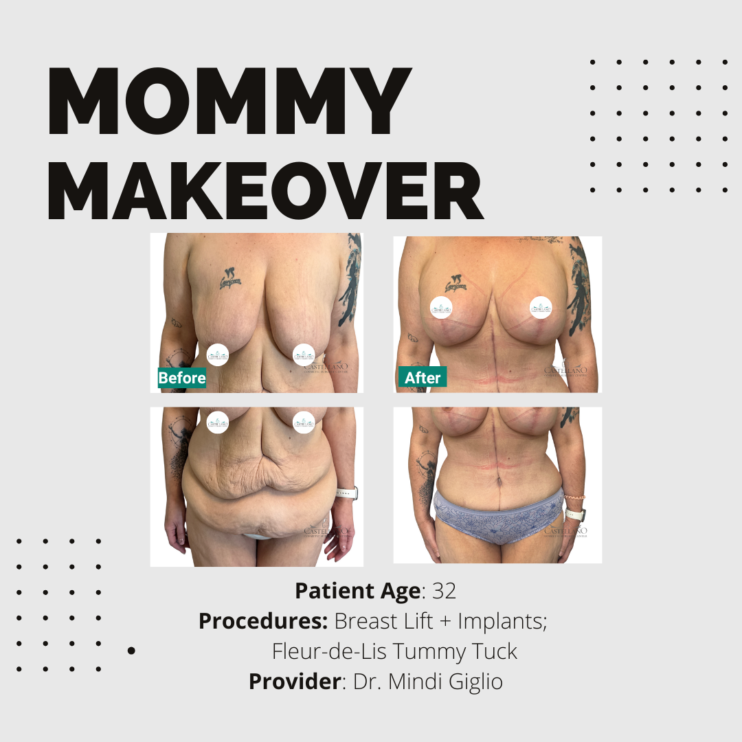 Mommy Makeover (Virtual Consult)