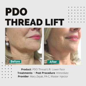 PDO Thread Lift