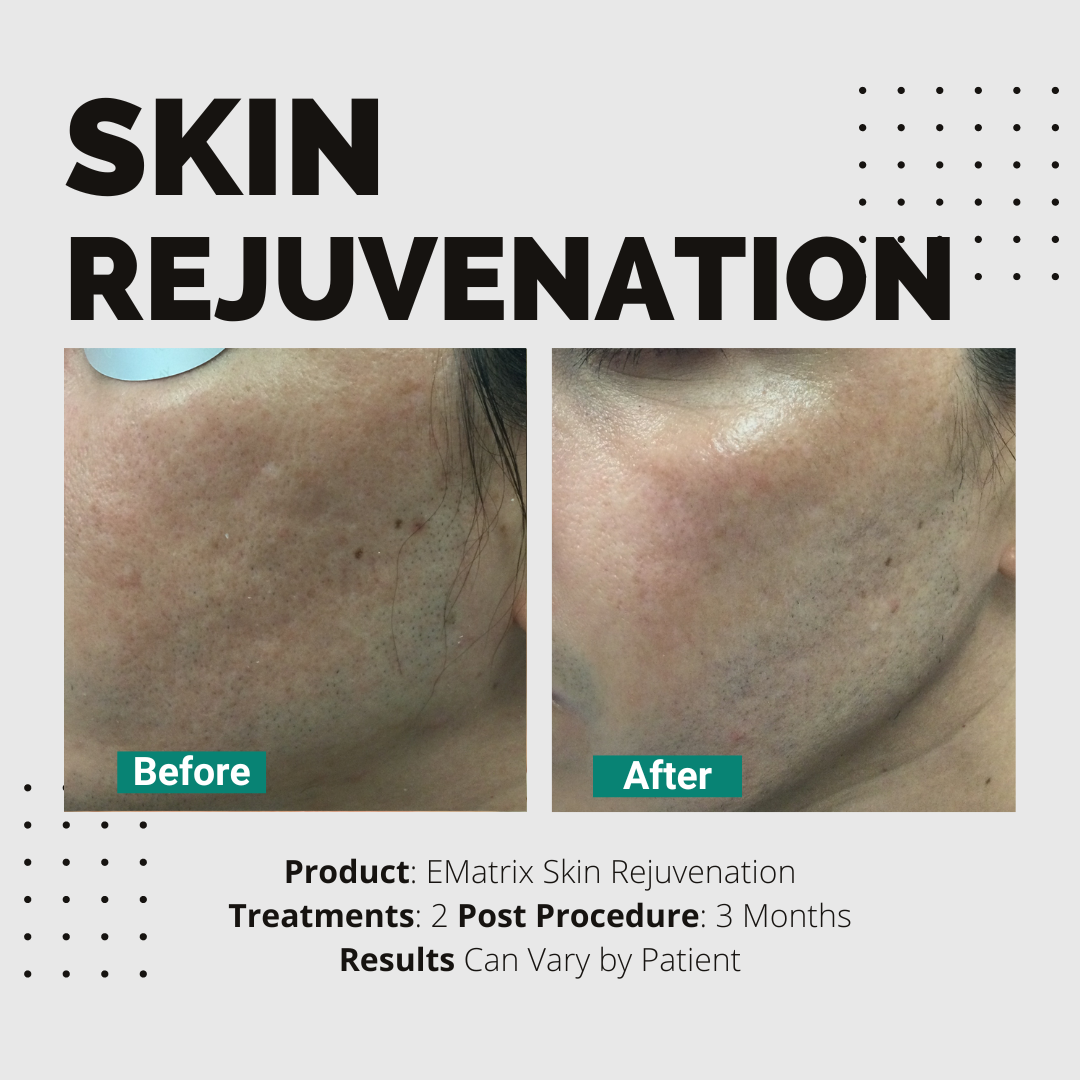 Skin Rejuvenation