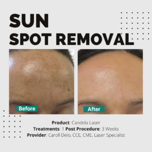Sun Spot Removal