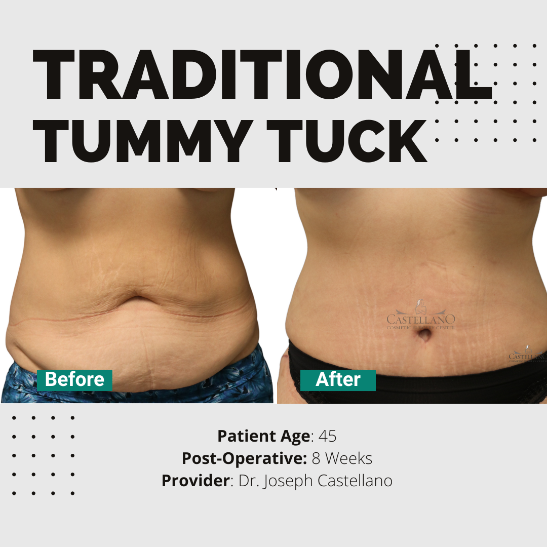 Tummy Tuck (Virtual Consult)