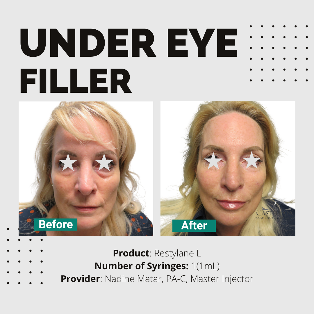 Under Eye Filler