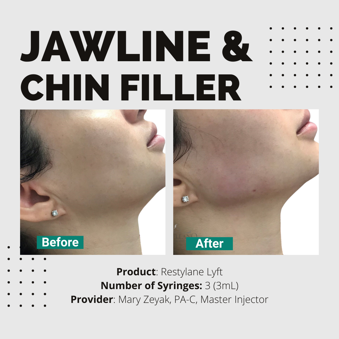 Chin/Jaw Filler