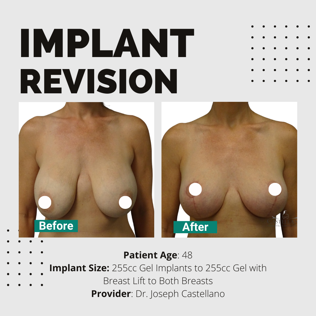 Implant Revision (Virtual Consult)