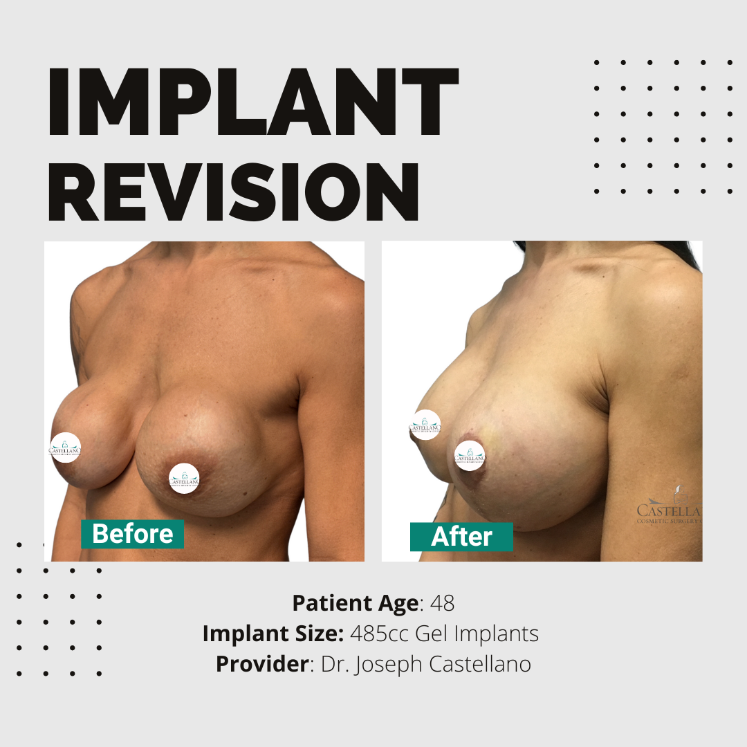 Implant Revision - Image 2