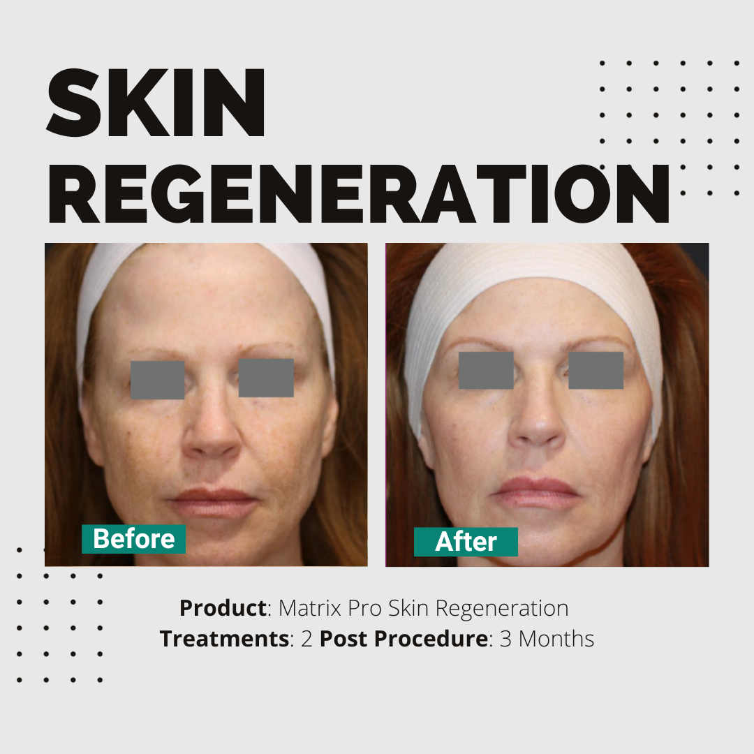 Skin Regeneration