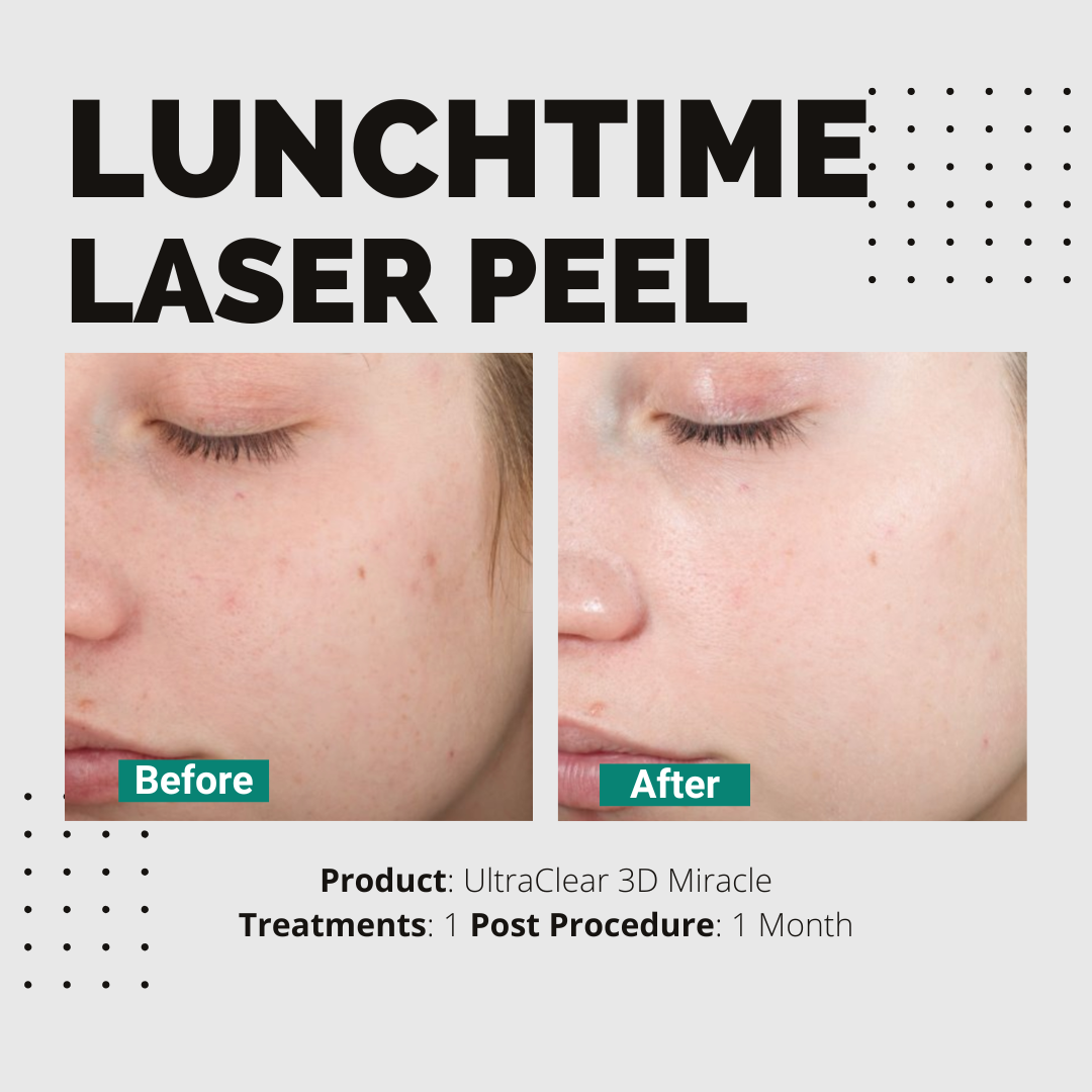Lunchtime Laser Peel (3DMIRACL)