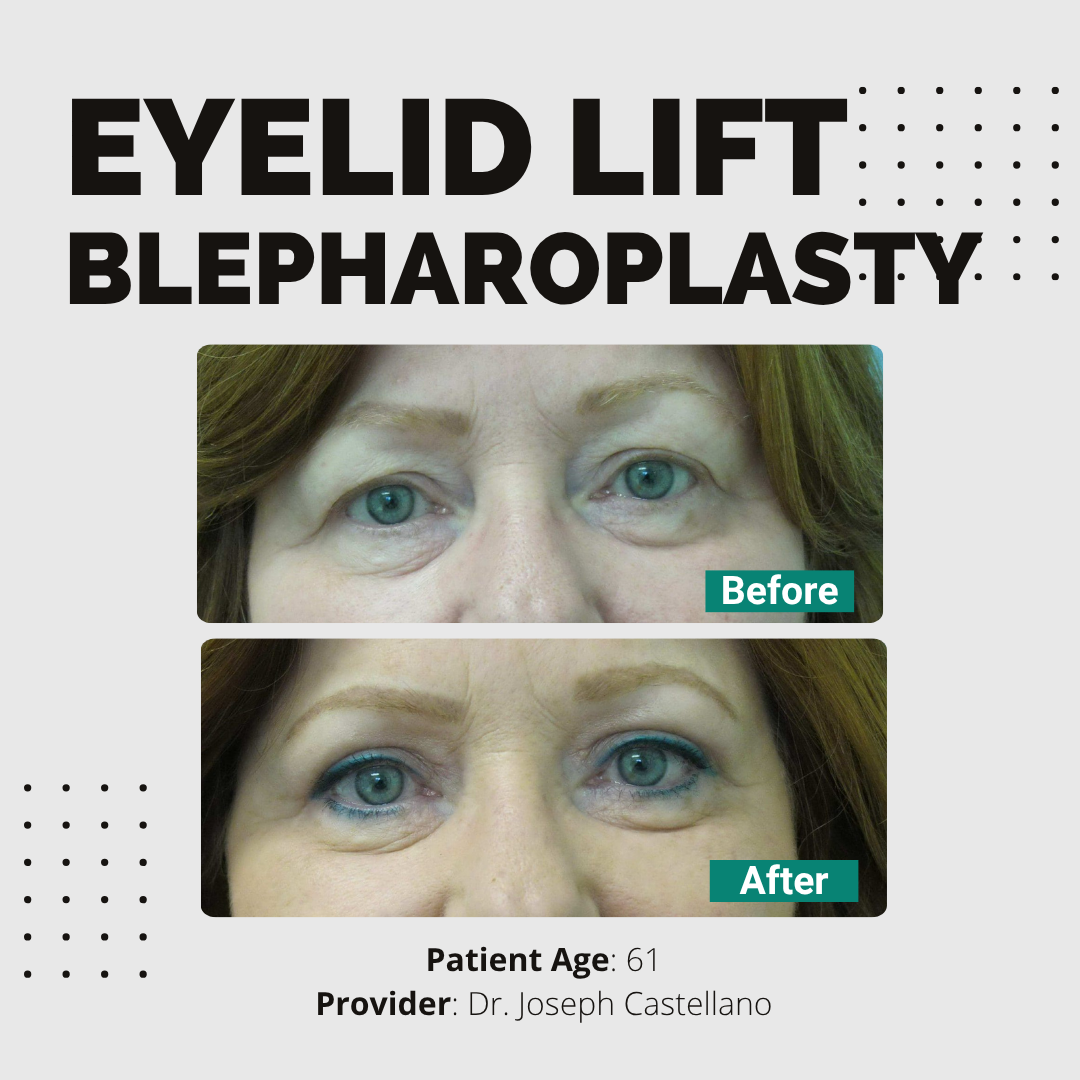 Blepharoplasty