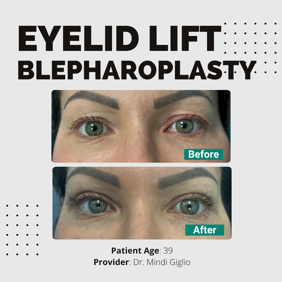 Blepharoplasty - Image 2